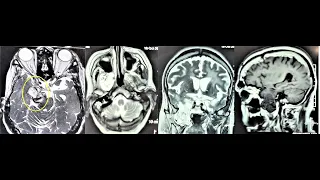 TRIGEMINAL SCHWANNOMA-LARGE MULTICOMPARTMENTAL MICROSURGERY-@dr suresh dugani/@HUBBALLI/@INDIA