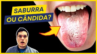 LÍNGUA BRANCA: SABURRA OU CÂNDIDA? DESCUBRA AGORA!