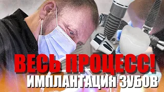 Имплантация зубов, весь процесс