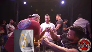 Broken Arm at King of the Table 2 After Pull (Oleg vs Vasyl)