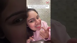 Straighten crooked teeth in 6-8~ months | Pavitra's toothsimonial | makeO toothsi clear aligners
