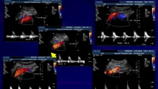 Aorto iliac Ultrasound