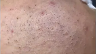 Satisfying and relaxing blackheads, pimple pop - Nhat Bang Acne Treatment - Chuyen Nguyen Spa #21