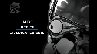 MRI ORBITS – w/dedicated coil