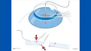 Corneal Suturing, Part 2 - Placing the Needle Into the Graft