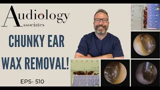 CHUNKY EAR WAX REMOVAL - EP510