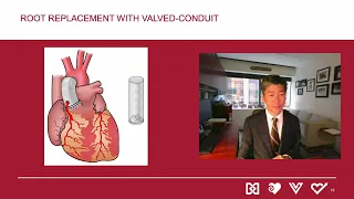 Surgery for Sporadic Aortic Aneurysms of the Aortic Root and Ascending Aorta