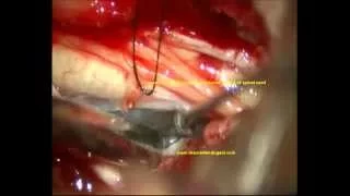 NEURENTERIC CYST-Thoracic spine-microsurgery-dr suresh dugani/ HUBLI/KARNATAK/INDIA