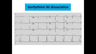 ECG course: Isorhythmic AV dissociation, Dr. Sherif Altoukhy