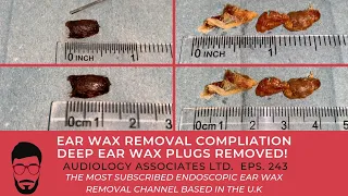 EAR WAX REMOVAL COMPILATION - DEEP EAR WAX PLUGS REMOVED - EP 243