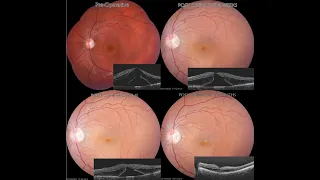 Vitrectomy for Optic Disc Pit Maculopathy