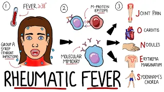 Rheumatic Fever Made Easy (Including Jones Criteria and Mnemonic!)