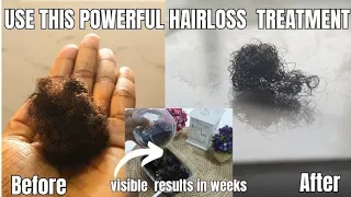 Don't Rinse Out!Only 3 ingredients to stop hair loss in weeks |ALOPECIA AREATA TREATMENT