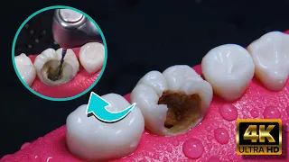 AMAZING reconstruction of tooth damaged by caries: Endodontics