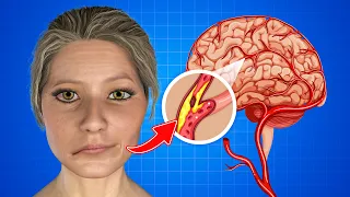 7 Warning Signs of Stroke One Month Before