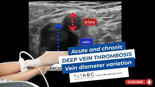 Acute and chronic Deep vein thrombosis. Vein diameter variation | Ultrasound