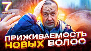 Приживаемость волос после пересадки. Ждал 2,5 месяца результата. Рост новых волос по осени.