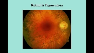 Retinitis Pigmentosa   CRASH! USMLE Step 2 and 3