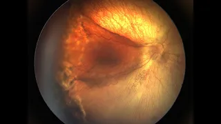 ROP stage 4A with anterior retinal traction