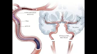 4.5 Minute Thrombectomy Using the ADAPT-FAST Technique and the ACE68 Catheter