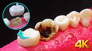 AMAZING Tooth Decay Restoration: Crown in 4K