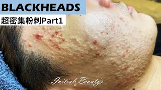 超密集粉刺part1( blackheads ) - Taiwan Tainan台南清粉刺最乾淨