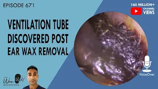 671 - Ventilation Tube Discovered Post Ear Wax Removal