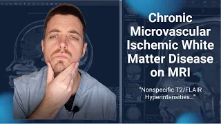 Chronic Microvascular Ischemic White Matter Disease of the Brain on MRI