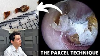 'Parcel Technique' Used To Extracted Tough Ear Wax