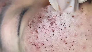 HANA #74: AN AWESOME BLACKHEADS FIELD