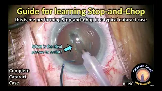 CataractCoach 1190: learning the stop and chop phaco technique