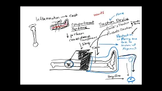 Learn NCLEX Now: Traction device and long bone fracture