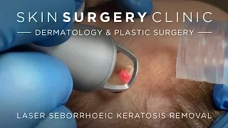 Seborrhoeic Keratosis Removal - See The Treatment