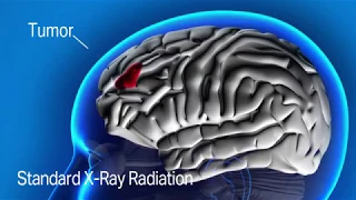 Proton Therapy vs Standard Radiation in Cancer Treatment