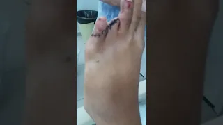 Rapaz perde dedo em  acidente  de  moto