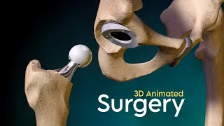 Total Hip Replacement Surgery (3D Animation)  | 5 Types |