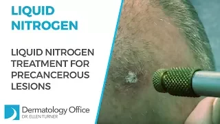 Liquid nitrogen for precancer