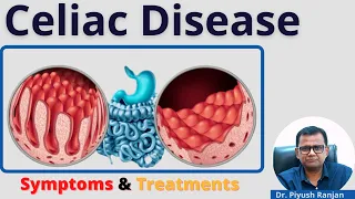 Celiac Disease (Wheat Allergy) : Symptoms, Causes, Diagnoses, Risk Factors & Treatments (हिंदी)