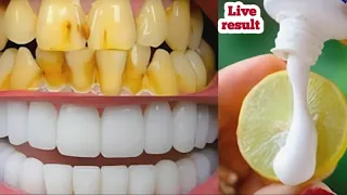 सिर्फ 2 मिनट में गंदे दांतों को मोती की तरह चमका देगा यह घेरेलू नुस्खा Teeth whitening remedy