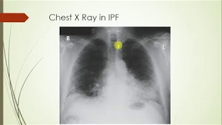 idiopathic pulmonary fibrosis: Clinical case review, symptoms, DDs, investigations, Treatment