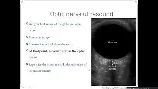 PoCUs:Ocular ultrasound to measure Increased ICP.