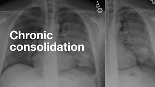 Chronic Consolidation