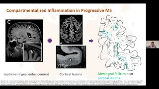 Multiple Sclerosis Lecture Series: Novel Therapies