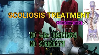 SCOLIOSIS TREATMENT | No Brace, No Surgery | Using specialized table