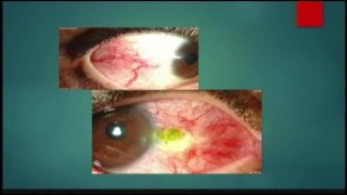 lmmune Related Eye Diseases