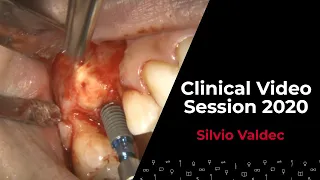 Autologous Dentin Graft from the Wisdom Tooth w/ Silvio VALDEC | Clinical Video Session 2020