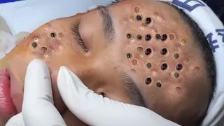 Make your Acne Treatment Huong Da Nang​ | acne 2022 Part10