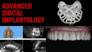 All on four. Msoft. Intraoral welding. Lego bridge. Prosthetic oriented guided surgery.