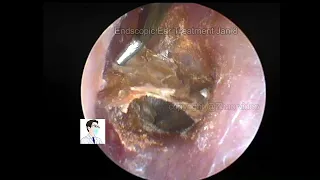 Ear wax removal 20220108