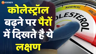 Hume Fikr Hai Aapki Live : Cholesterol बढ़ने पर पैरों में दिखते है ये लक्षण, जानें एक्सपर्ट्स से